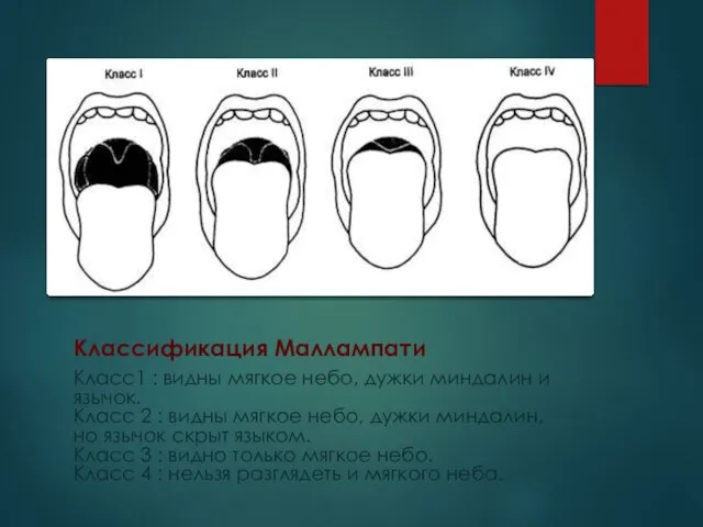 Классификация Маллампати Класс1 : видны мягкое небо, дужки миндалин и