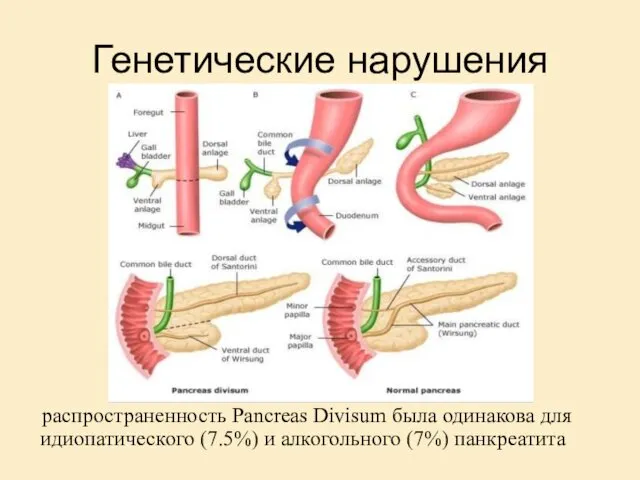 Генетические нарушения распространенность Pancreas Divisum была одинакова для идиопатического (7.5%) и алкогольного (7%) панкреатита