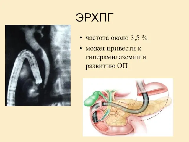ЭРХПГ частота около 3,5 % может привести к гиперамилаземии и развитию ОП