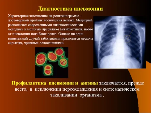 Характерное затемнение на рентгенограмме - достоверный признак воспаления легких. Медицина