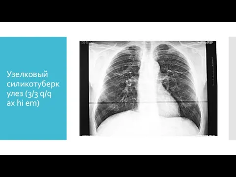 Узелковый силикотуберкулез (3/3 q/q ax hi em)