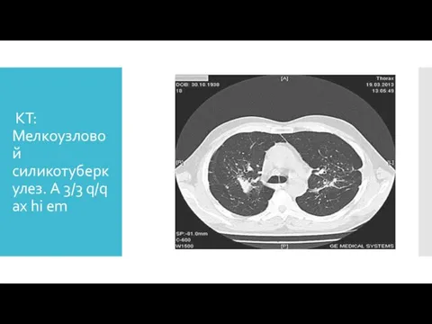 КТ: Мелкоузловой силикотуберкулез. A 3/3 q/q ax hi em