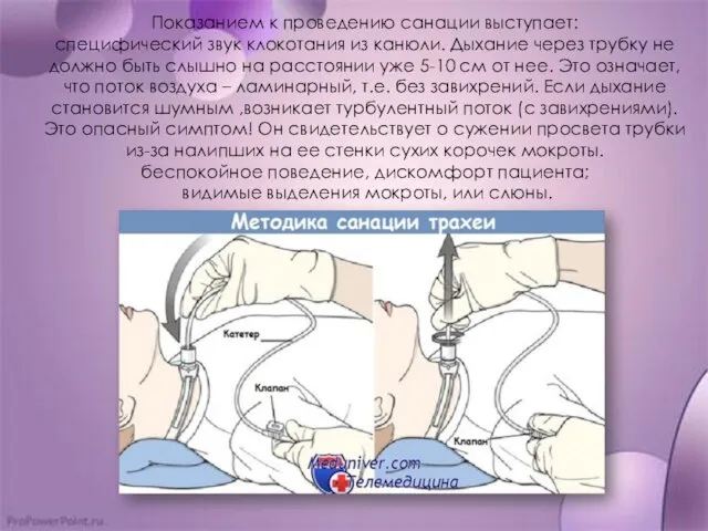 Показанием к проведению санации выступает: специфический звук клокотания из канюли.