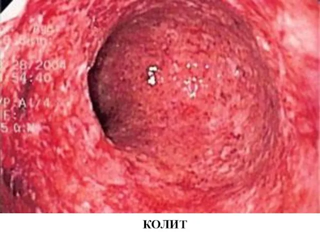 КОЛИТ