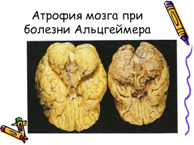 Атрофия мозга при болезни Альцгеймера