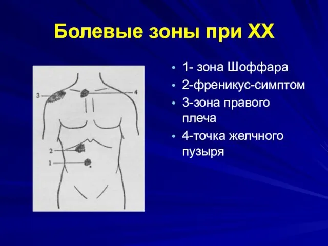 Болевые зоны при ХХ 1- зона Шоффара 2-френикус-симптом 3-зона правого плеча 4-точка желчного пузыря