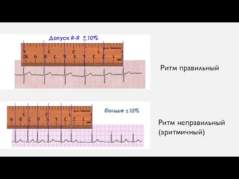 Ритм правильный Ритм неправильный (аритмичный)