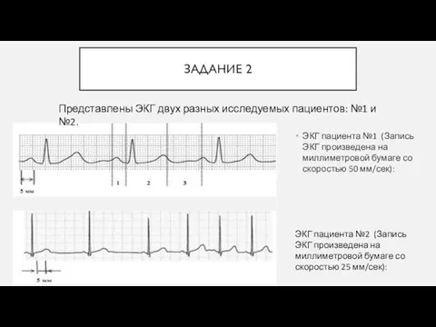 ЗАДАНИЕ 2 ЭКГ пациента №1 (Запись ЭКГ произведена на миллиметровой