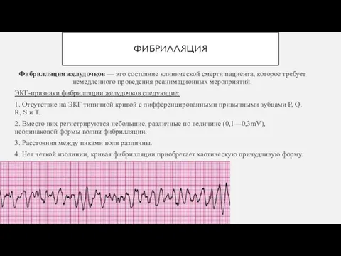 ФИБРИЛЛЯЦИЯ Фибрилляция желудочков — это состояние клинической смерти пациента, которое