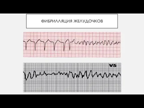 ФИБРИЛЛЯЦИЯ ЖЕЛУДОЧКОВ