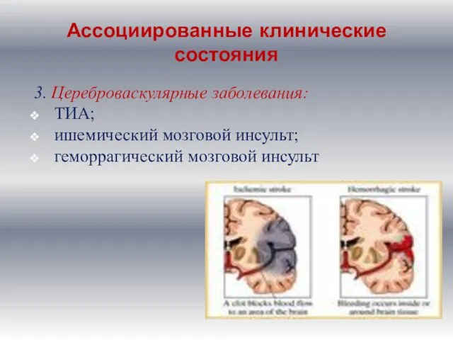 Ассоциированные клинические состояния 3. Цереброваскулярные заболевания: ТИА; ишемический мозговой инсульт; геморрагический мозговой инсульт