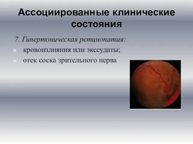 Ассоциированные клинические состояния 7. Гипертоническая ретинопатия: кровоизлияния или экссудаты; отек соска зрительного нерва