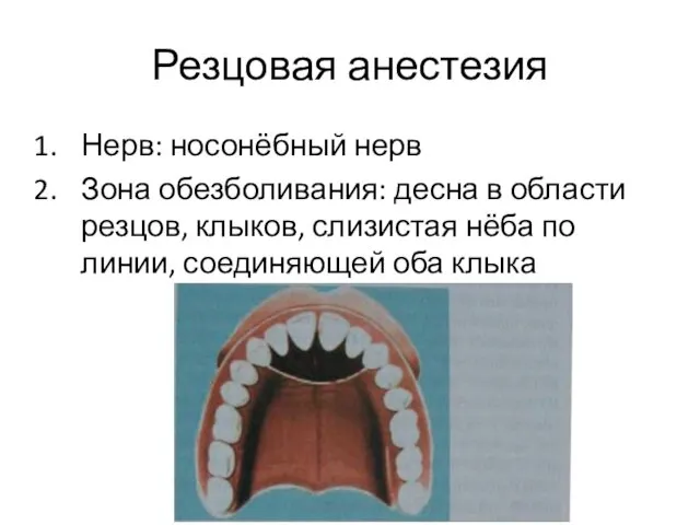 Резцовая анестезия Нерв: носонёбный нерв Зона обезболивания: десна в области