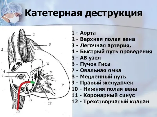 Катетерная деструкция 1 - Аорта 2 - Верхняя полая вена