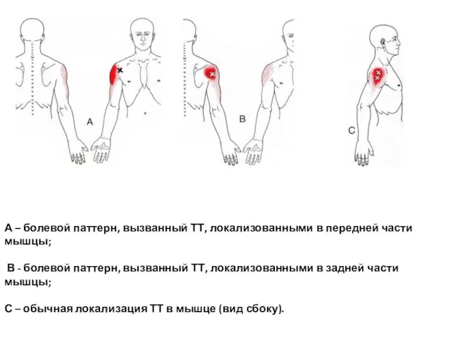 А – болевой паттерн, вызванный ТТ, локализованными в передней части мышцы; В -