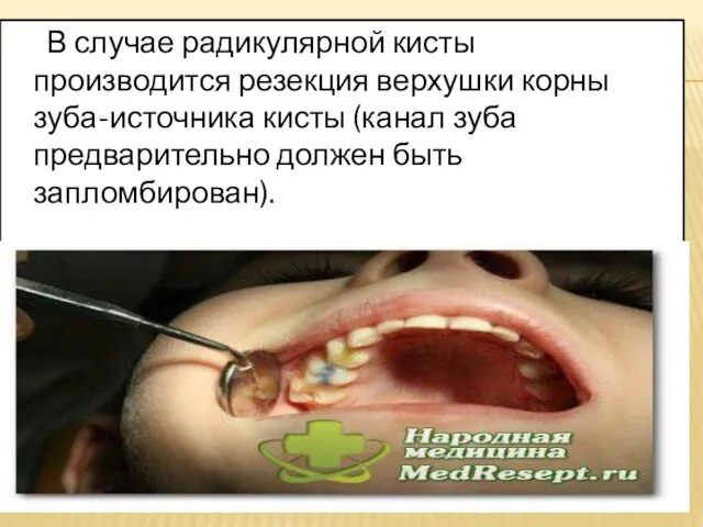 В случае радикулярной кисты производится резекция верхушки корны зуба-источника кисты (канал зуба предварительно должен быть запломбирован).