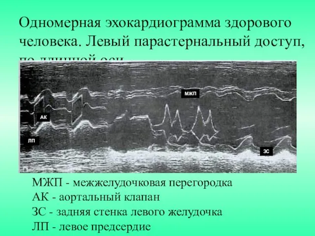 Одномерная эхокардиограмма здорового человека. Левый парастернальный доступ, по длинной оси.