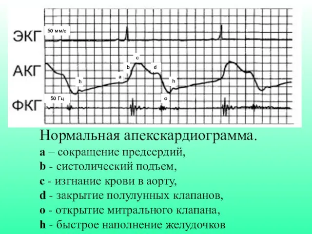 Нормальная апекскардиограмма. а – сокращение предсердий, b - cистолический подъем,