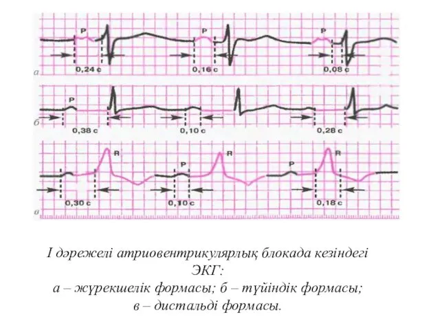 І дәрежелі атриовентрикулярлық блокада кезіндегі ЭКГ: а – жүрекшелік формасы;