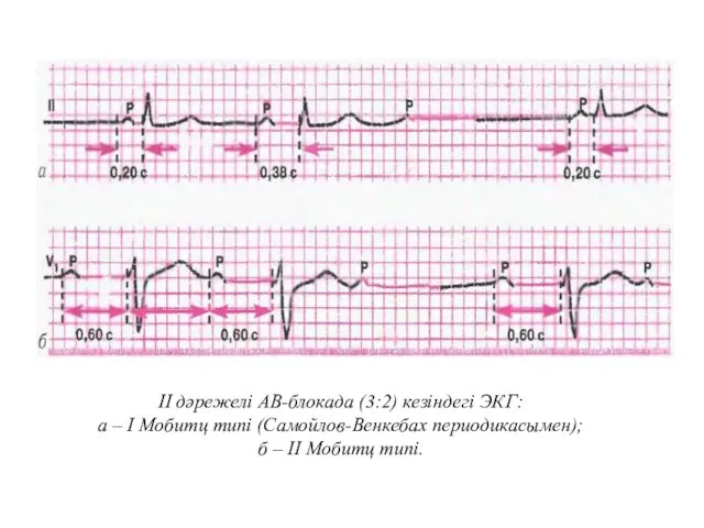 ІІ дәрежелі АВ-блокада (3:2) кезіндегі ЭКГ: а – І Мобитц