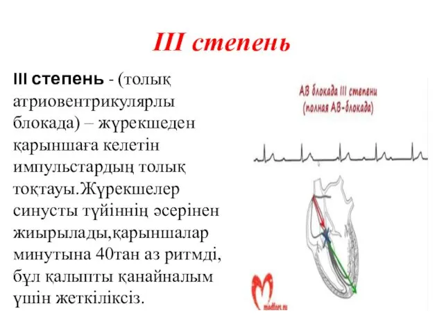 III степень III степень - (толық атриовентрикулярлы блокада) – жүрекшеден