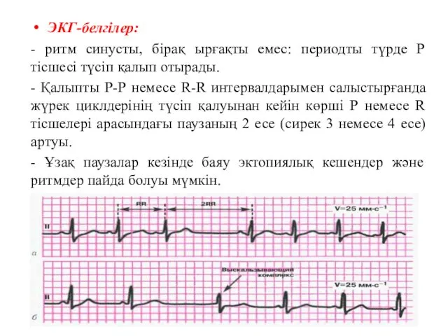 ЭКГ-белгілер: - ритм синусты, бірақ ырғақты емес: периодты түрде Р