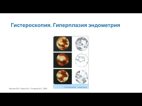 Гистероскопия. Гиперплазия эндометрия Кулаков В.И., Серов В.Н., Гаспаров А.С., 2005
