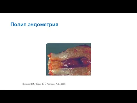Полип эндометрия Кулаков В.И., Серов В.Н., Гаспаров А.С., 2005