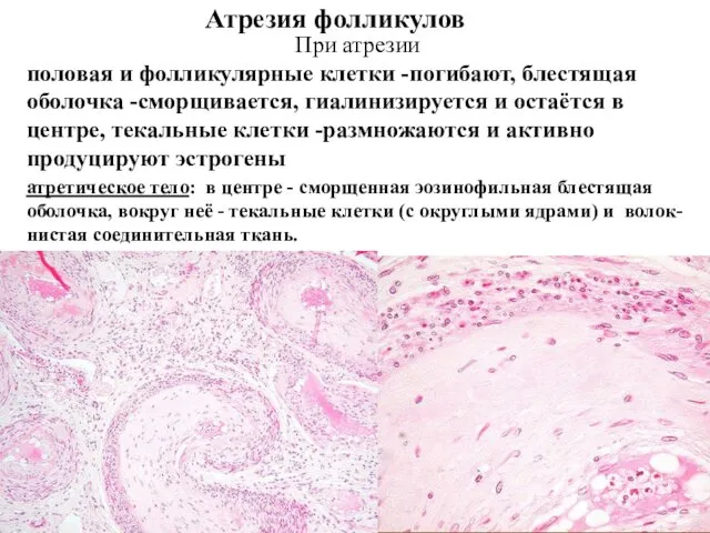 Атрезия фолликулов атретическое тело: в центре - сморщенная эозинофильная блестящая оболочка, вокруг неё