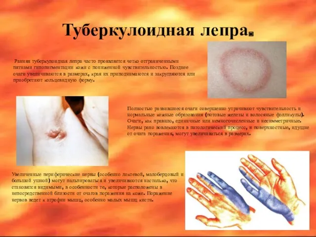 Туберкулоидная лепра. Ранняя туберкулоидная лепра часто проявляется четко отграниченными пятнами гипопигментации кожи с