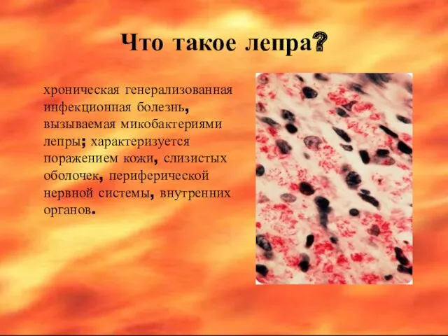 Что такое лепра? хроническая генерализованная инфекционная болезнь, вызываемая микобактериями лепры; характеризуется поражением кожи,