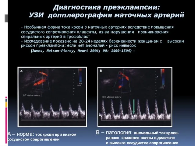 - Необычная форма тока крови в маточных артериях вследствие повышения