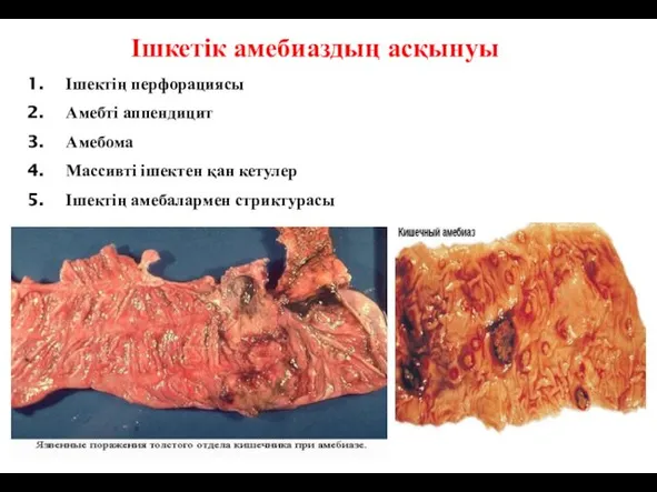 Ішкетік амебиаздың асқынуы Ішектің перфорациясы Амебті аппендицит Амебома Массивті ішектен қан кетулер Ішектің амебалармен стриктурасы