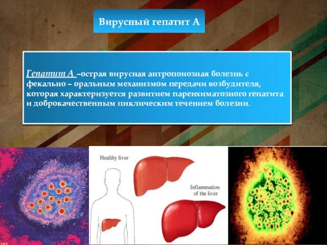 Вирусный гепатит А Гепатит А –острая вирусная антропонозная болезнь с