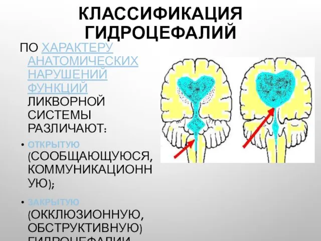 КЛАССИФИКАЦИЯ ГИДРОЦЕФАЛИЙ ПО ХАРАКТЕРУ АНАТОМИЧЕСКИХ НАРУШЕНИЙ ФУНКЦИЙ ЛИКВОРНОЙ СИСТЕМЫ РАЗЛИЧАЮТ: