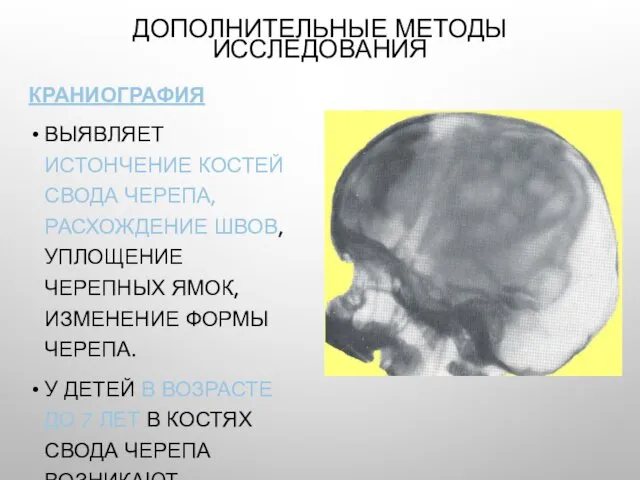 ДОПОЛНИТЕЛЬНЫЕ МЕТОДЫ ИССЛЕДОВАНИЯ КРАНИОГРАФИЯ ВЫЯВЛЯЕТ ИСТОНЧЕНИЕ КОСТЕЙ СВОДА ЧЕРЕПА, РАСХОЖДЕНИЕ