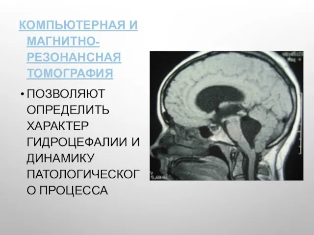 КОМПЬЮТЕРНАЯ И МАГНИТНО-РЕЗОНАНСНАЯ ТОМОГРАФИЯ ПОЗВОЛЯЮТ ОПРЕДЕЛИТЬ ХАРАКТЕР ГИДРОЦЕФАЛИИ И ДИНАМИКУ ПАТОЛОГИЧЕСКОГО ПРОЦЕССА