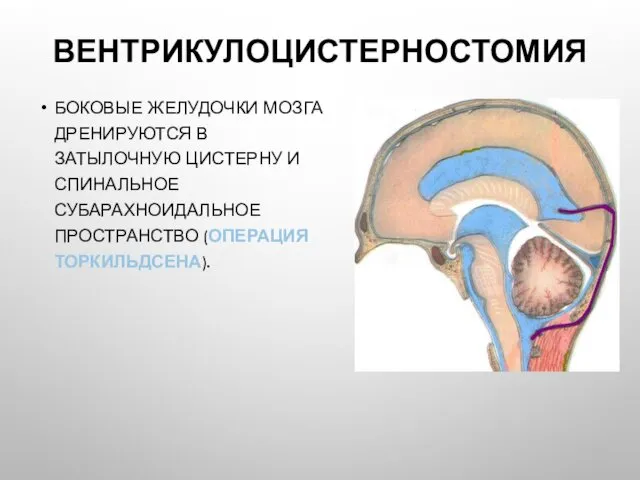 ВЕНТРИКУЛОЦИСТЕРНОСТОМИЯ БОКОВЫЕ ЖЕЛУДОЧКИ МОЗГА ДРЕНИРУЮТСЯ В ЗАТЫЛОЧНУЮ ЦИСТЕРНУ И СПИНАЛЬНОЕ СУБАРАХНОИДАЛЬНОЕ ПРОСТРАНСТВО (ОПЕРАЦИЯ ТОРКИЛЬДСЕНА).