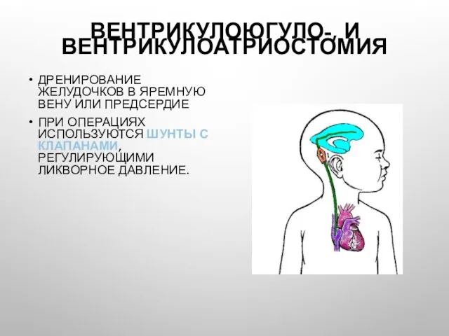 ВЕНТРИКУЛОЮГУЛО-, И ВЕНТРИКУЛОАТРИОСТОМИЯ ДРЕНИРОВАНИЕ ЖЕЛУДОЧКОВ В ЯРЕМНУЮ ВЕНУ ИЛИ ПРЕДСЕРДИЕ