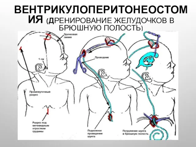 ВЕНТРИКУЛОПЕРИТОНЕОСТОМИЯ (ДРЕНИРОВАНИЕ ЖЕЛУДОЧКОВ В БРЮШНУЮ ПОЛОСТЬ)