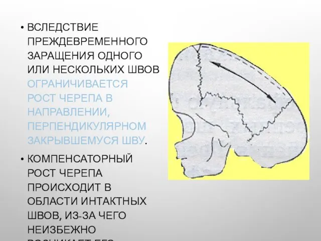 ВСЛЕДСТВИЕ ПРЕЖДЕВРЕМЕННОГО ЗАРАЩЕНИЯ ОДНОГО ИЛИ НЕСКОЛЬКИХ ШВОВ ОГРАНИЧИВАЕТСЯ РОСТ ЧЕРЕПА