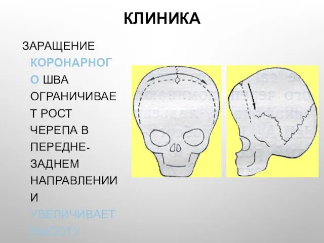 КЛИНИКА ЗАРАЩЕНИЕ КОРОНАРНОГО ШВА ОГРАНИЧИВАЕТ РОСТ ЧЕРЕПА В ПЕРЕДНЕ-ЗАДНЕМ НАПРАВЛЕНИИ И УВЕЛИЧИВАЕТ ВЫСОТУ ГОЛОВЫ.