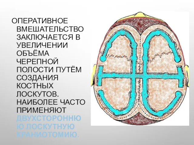 ОПЕРАТИВНОЕ ВМЕШАТЕЛЬСТВО ЗАКЛЮЧАЕТСЯ В УВЕЛИЧЕНИИ ОБЪЁМА ЧЕРЕПНОЙ ПОЛОСТИ ПУТЁМ СОЗДАНИЯ