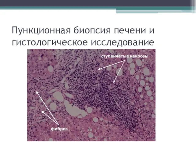 Пункционная биопсия печени и гистологическое исследование