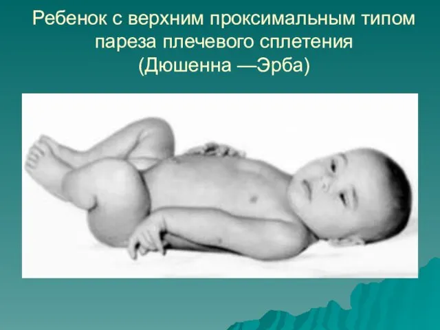 Ребенок с верхним проксимальным типом пареза плечевого сплетения (Дюшенна —Эрба)