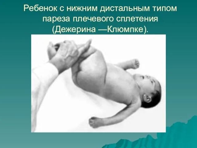 Ребенок с нижним дистальным типом пареза плечевого сплетения (Дежерина —Клюмпке).