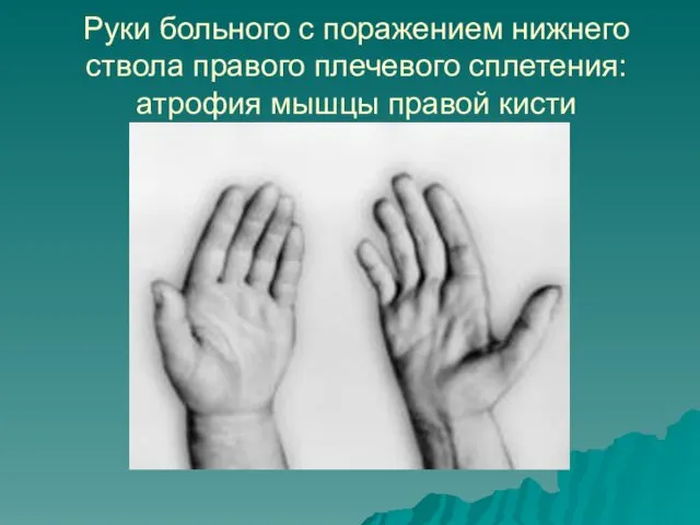 Руки больного с поражением нижнего ствола правого плечевого сплетения: атрофия мышцы правой кисти