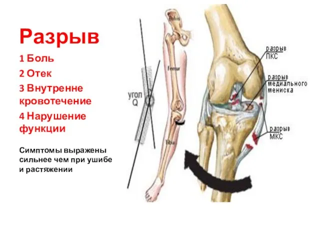 Разрыв 1 Боль 2 Отек 3 Внутренне кровотечение 4 Нарушение функции Симптомы выражены