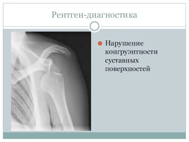 Рентген-диагностика Нарушение конгруэнтности суставных поверхностей