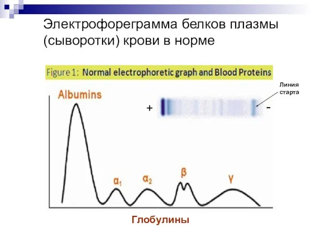 Электрофореграмма белков плазмы (сыворотки) крови в норме Глобулины - + Линия старта